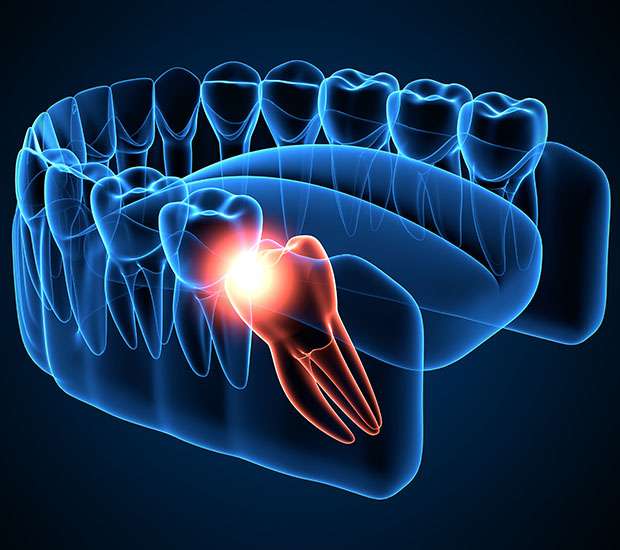 Miami Wisdom Teeth Extraction